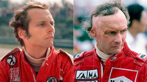 niki lauda before and after crash